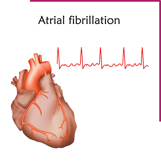 Atrial Fibrillation