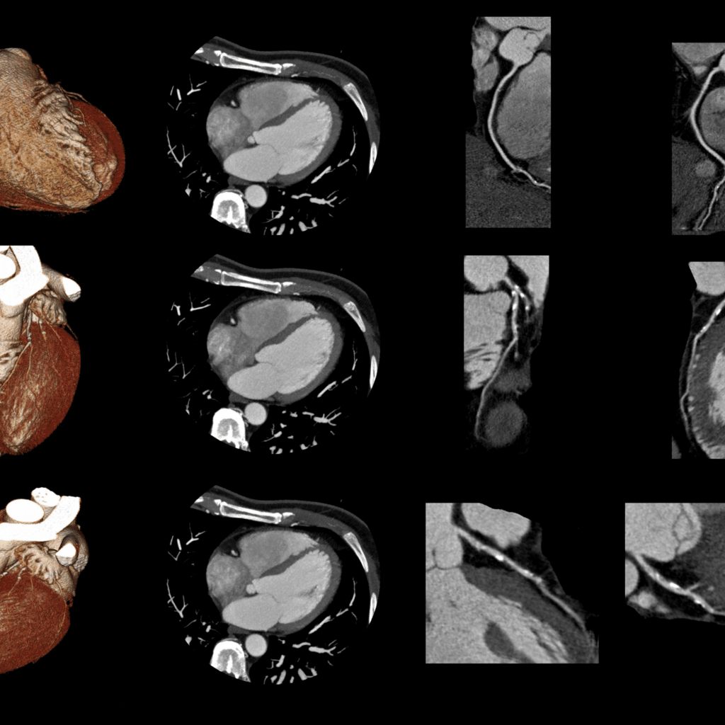 Cardiac computed tomography (cardiac CT)