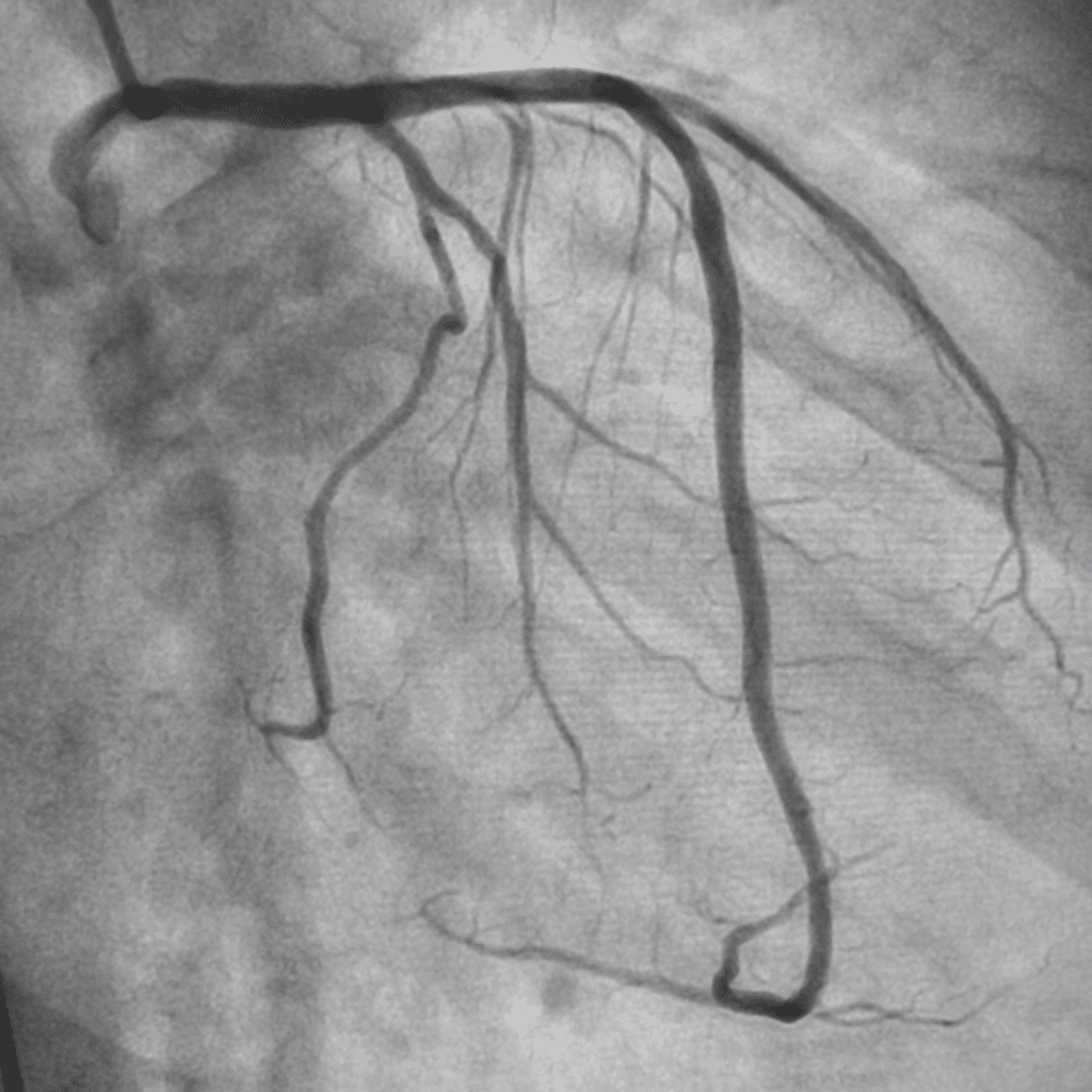 Coronary Angiography