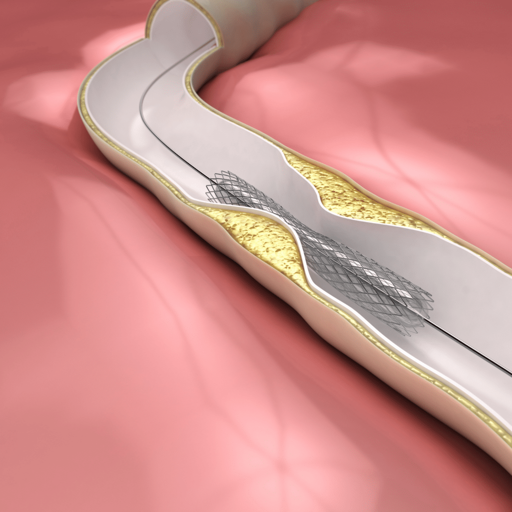 Coronary Angioplasty and Stenting