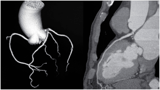 Carotid or femoral doppler ultrasound