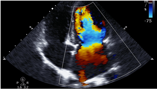 Echocardiogram