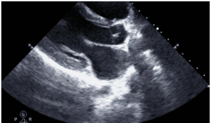 Echocardiography