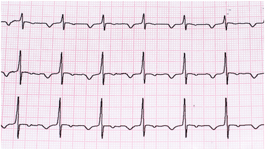 Electrocardiogram (ECG/EKG)