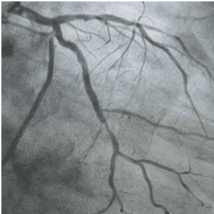 Invasive Coronary angiogram
