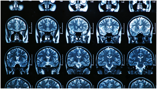 MRI Brain