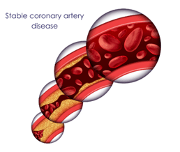 Stable coronary artery disease