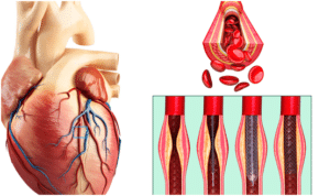 coronary angioplasty