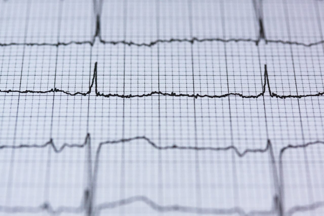 what-to-expect-during-an-ecg-test-in-singapore-dr-macdonald-cardiologist