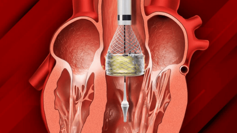 Transcatheter aortic valve implantation