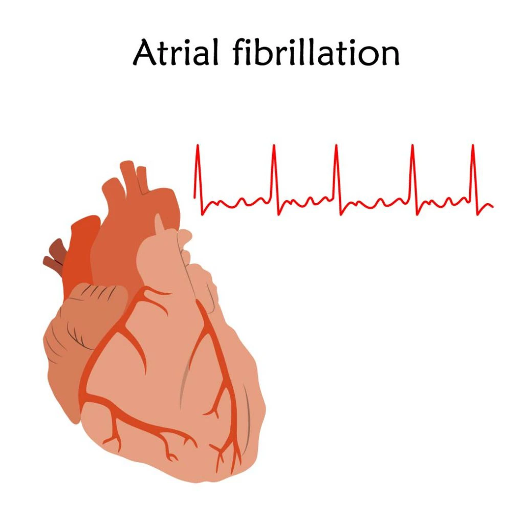 Sepse-Fibrilacao-Atrial-e-Envelhecimento_106186538
