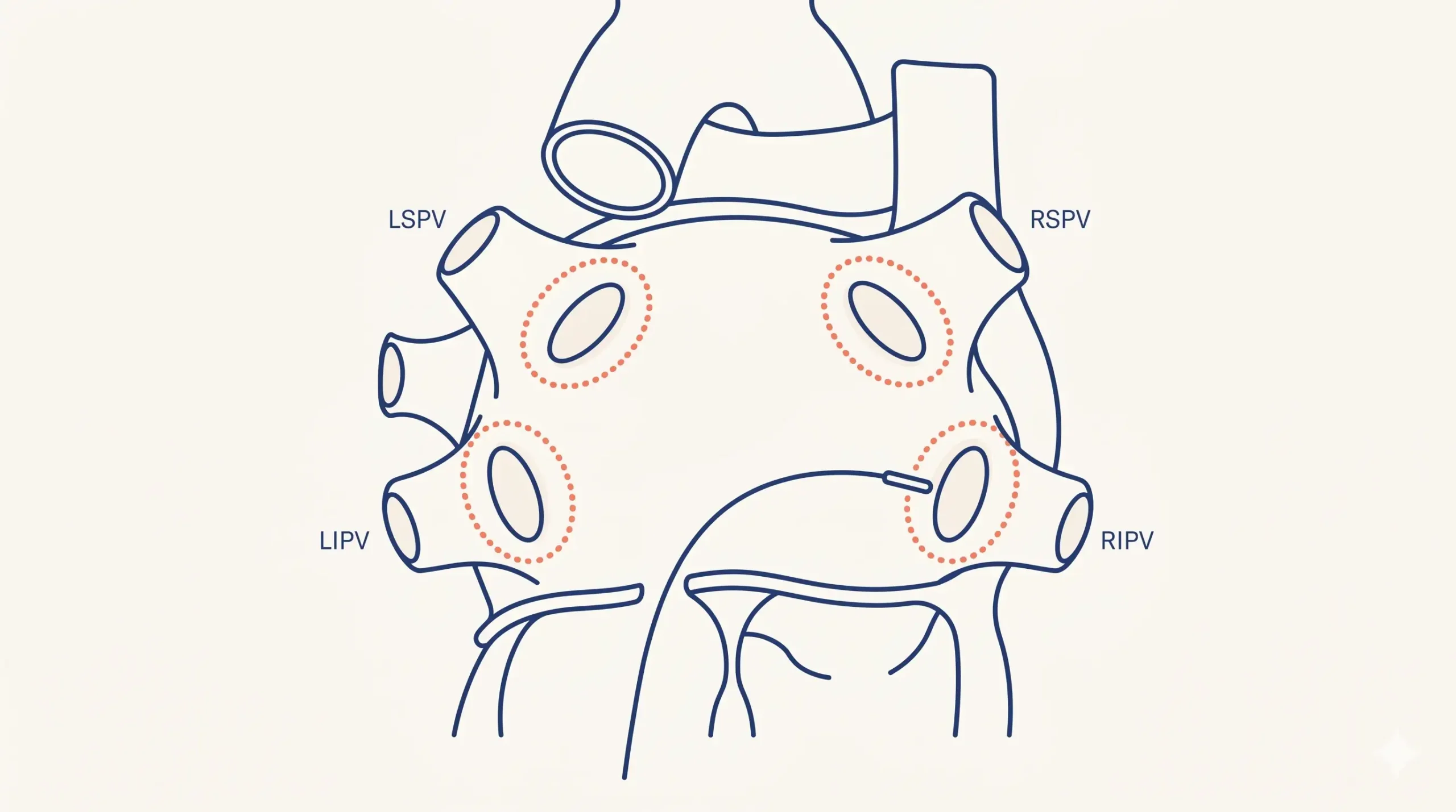 Cardiac ablation procedure